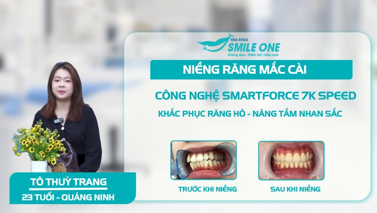 Khách hàng Thuỳ Trang: Chỉnh hô, sửa lệch tự tin rạng rỡ sau tháo niềng tại Smile One